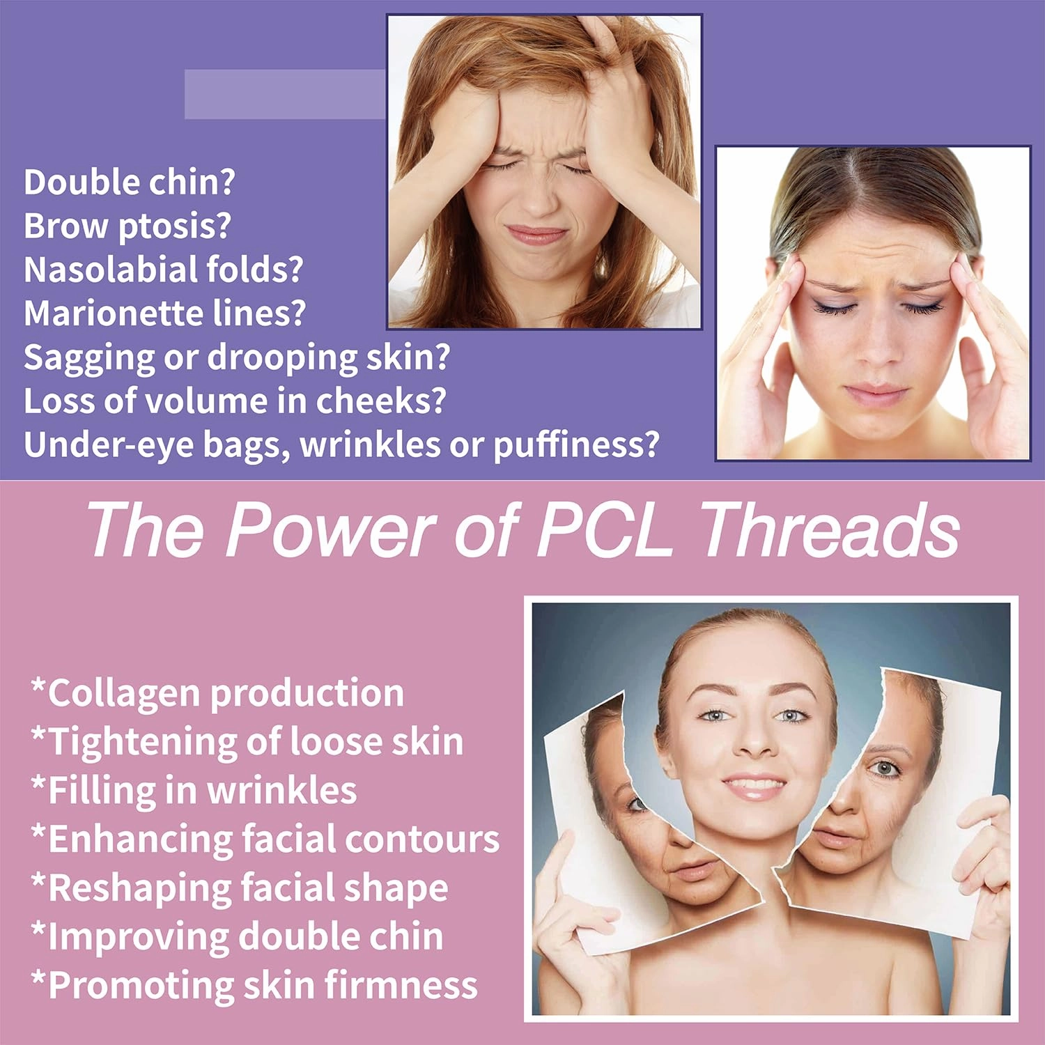 elves PCL Threads for Face Pcl Screw Thread Lift 29G38mm Mono Screw Type Face Lifting 20Pcs Facial Thread Smoothing Wrinkles with Sharp Tip