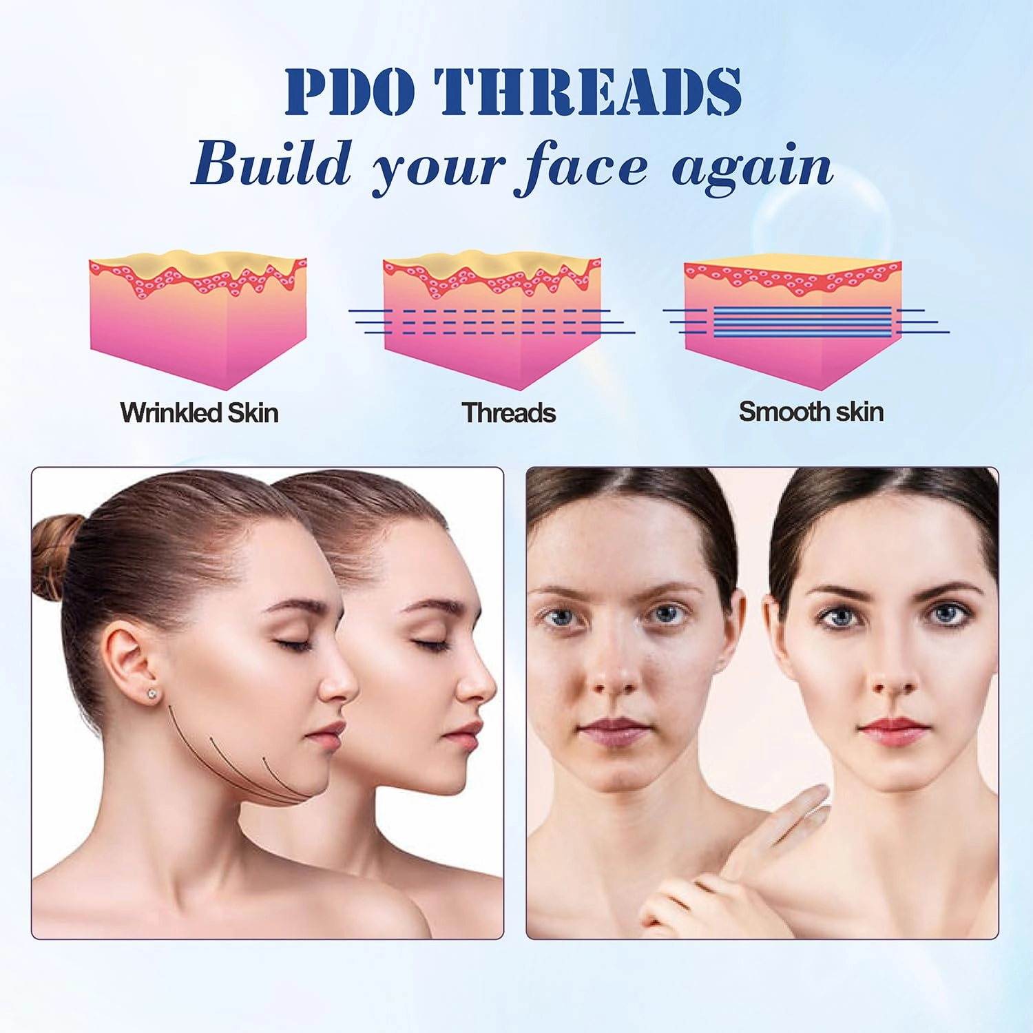 Pdo Threads, PDO Threads for Face Lift Mono Screw Type with Sharp Tip, Pdo Thread Facial Threads for Lifting 20Pcs (30G13MM)