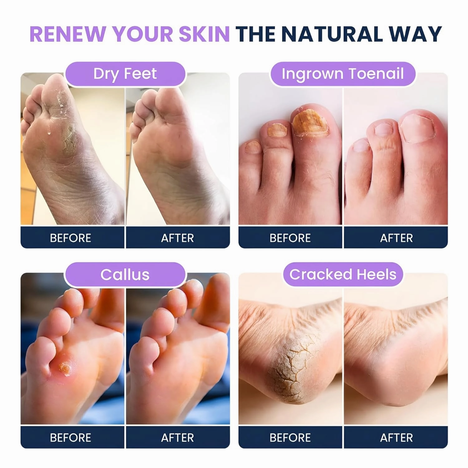 Soothing Lavender Foot Soak - Pedicure Foot Spa with Epson Salts for Soaking Feet - Foot Massager Spa - Foot Scrubber Dead Skin Remover - Epsom Salt Bath Soak