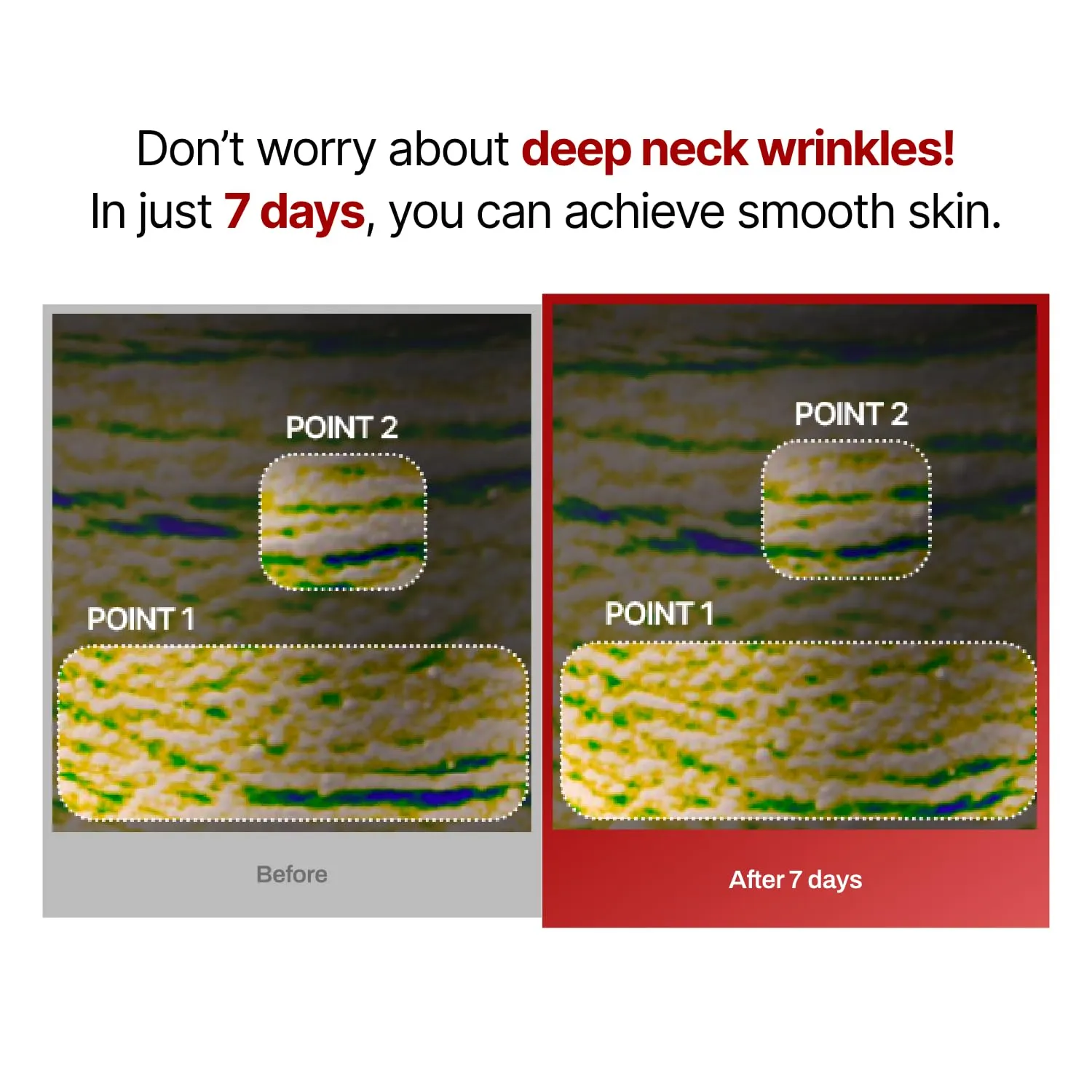 Wrinkle-fit Neck Mask 7EA   Boosting Roller - Neck Wrinkle Patches, Firming and Tightening Korean Deep Collagen Mask - NeckTargeted Mesh Sheet Mask and Face Roller for Lifting Sagging Skin